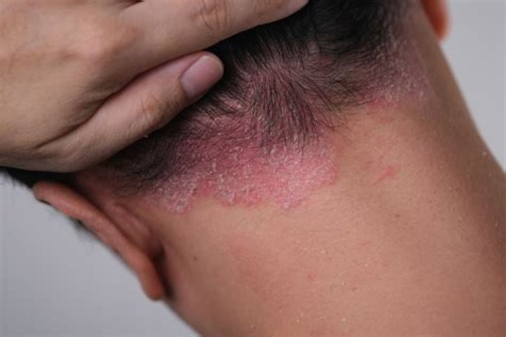 Are eggs bad for psoriasis?