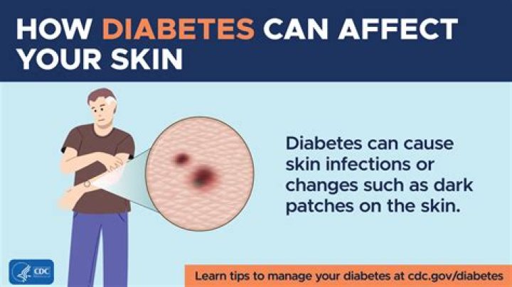 Are flushed cheeks a sign of diabetes?