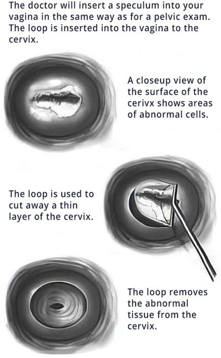 Are Leep and Lletz the same?