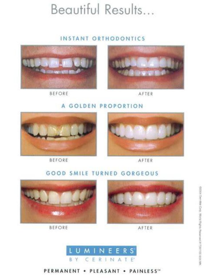 Are Lumineers reversible?