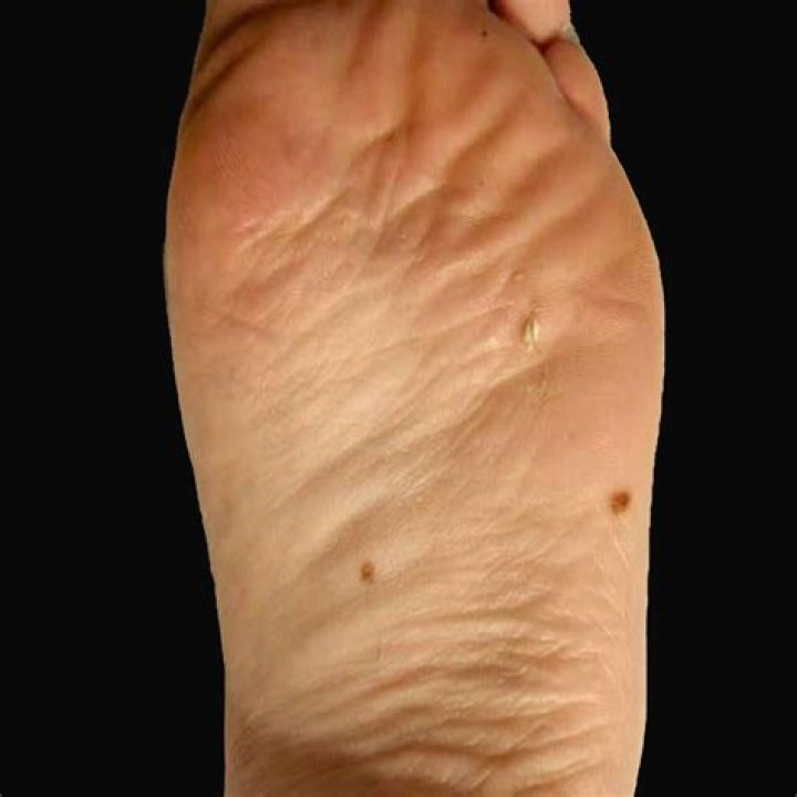 Are moles on feet dangerous?
