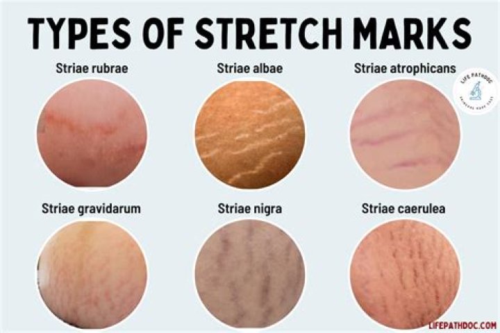 Are stretch marks normal for guys?