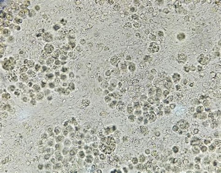 C'est quoi la Leucocyturie ?