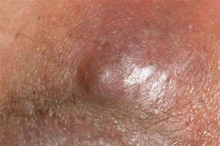 Can a boil leave a lump?