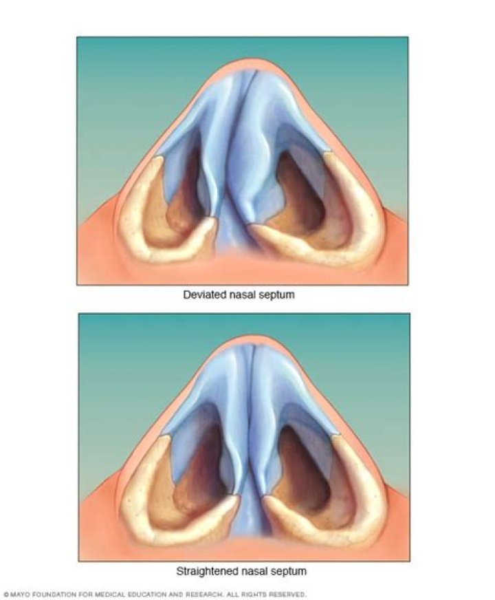 Can a deviated septum cause facial pain?