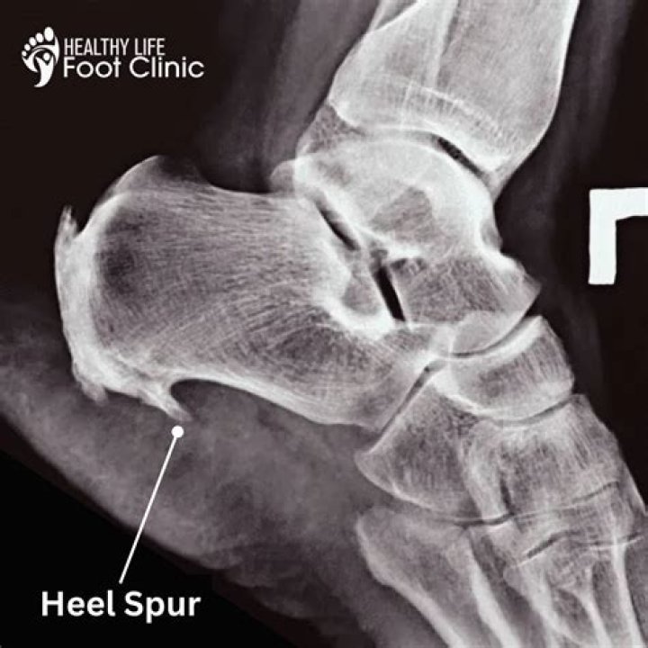 Can a heel spur go away on its own?