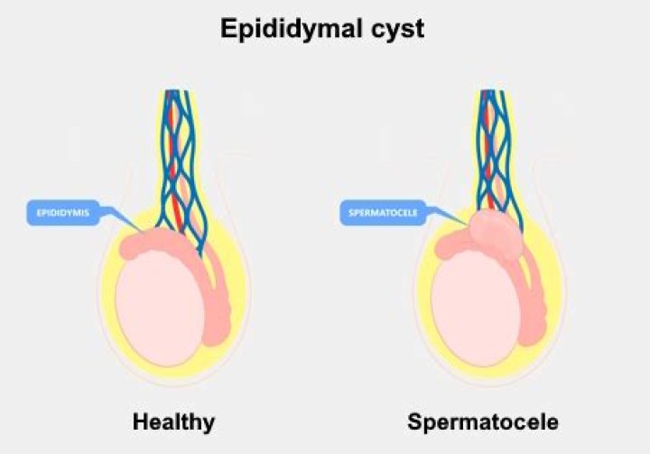 Can a Spermatocele go away on its own?
