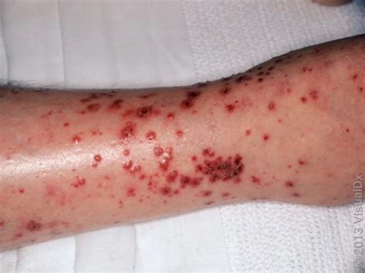 Can amlodipine cause rash and itching?