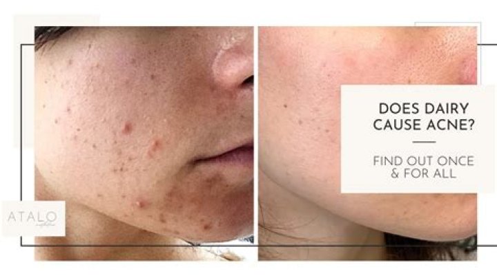 Can drinking milk cause acne?