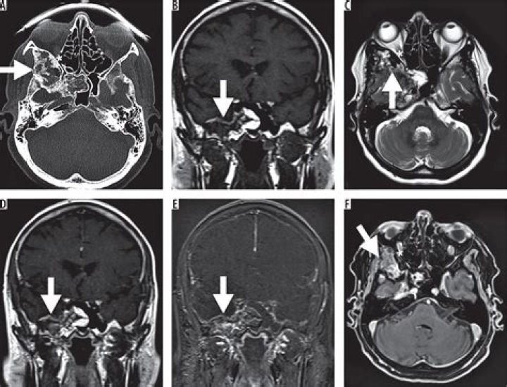 Can dysplasia be cured? | ContextResponse.com