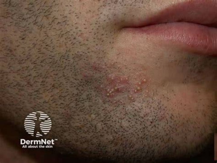 Can folliculitis last for months?
