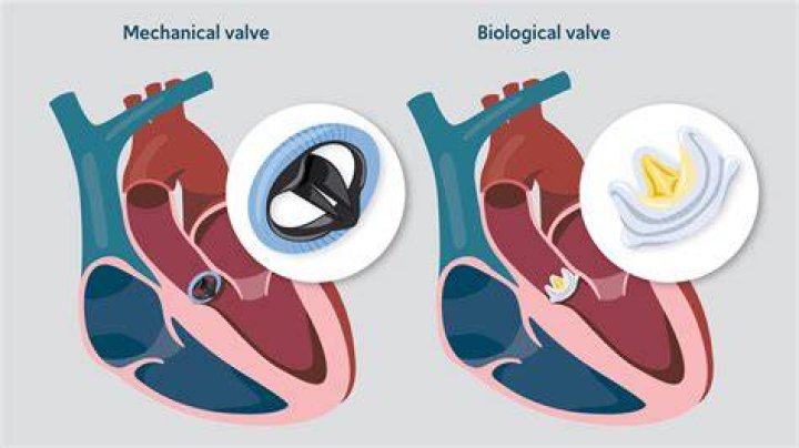 Can heart valves be cured?
