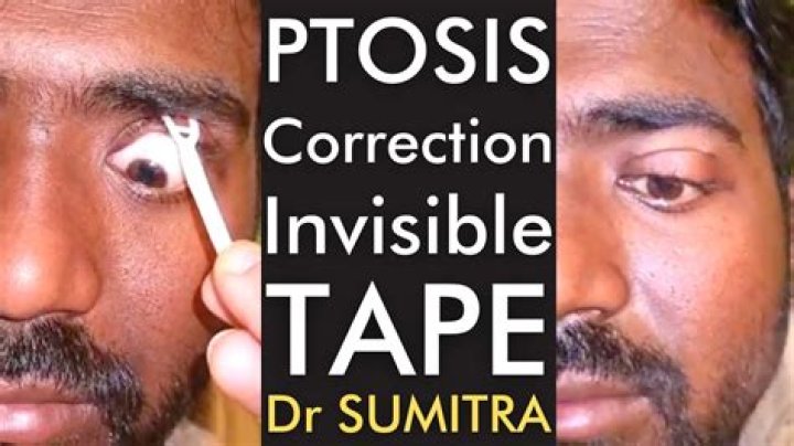 Can ptosis be cured without surgery?