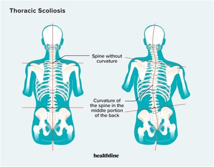 Can scoliosis cause other problems?