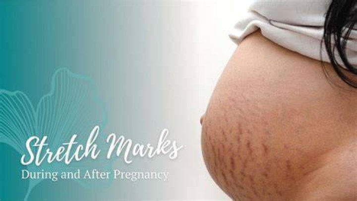 Can stretch marks go away after pregnancy?