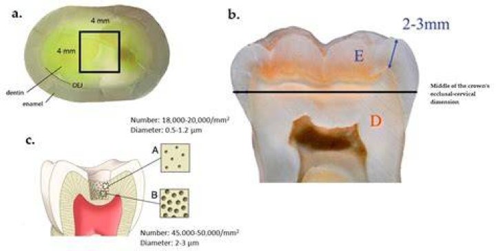 Can you cover exposed dentin?