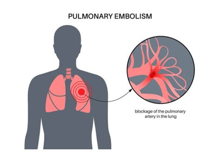 Can you die from a pulmonary embolism?