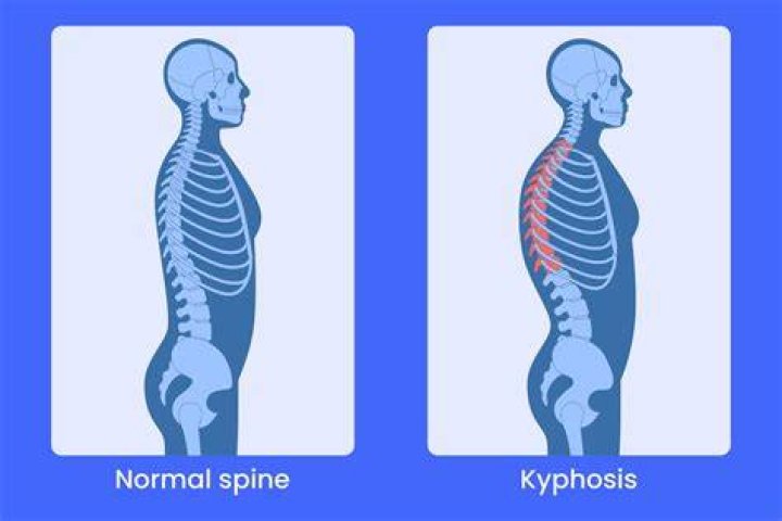 Can you die from kyphosis?