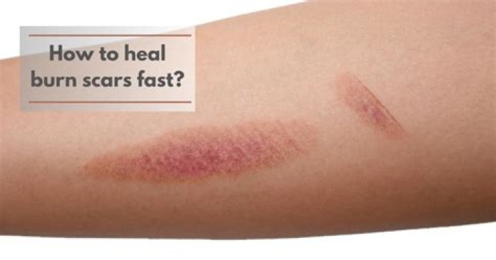 Can you get a scar from a sunburn?
