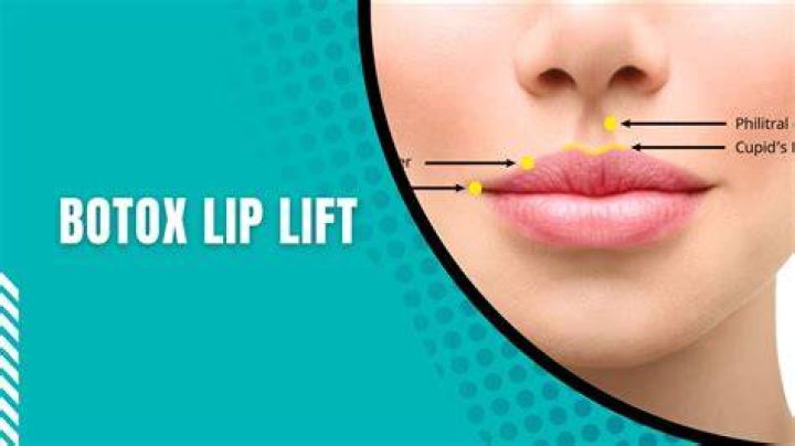 Can you get Botox around your mouth?