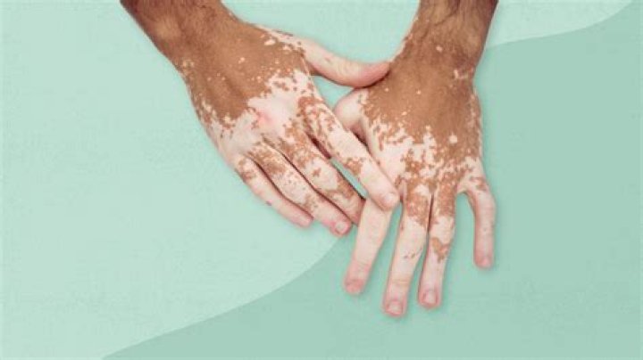 Can you get vitiligo on your lips?