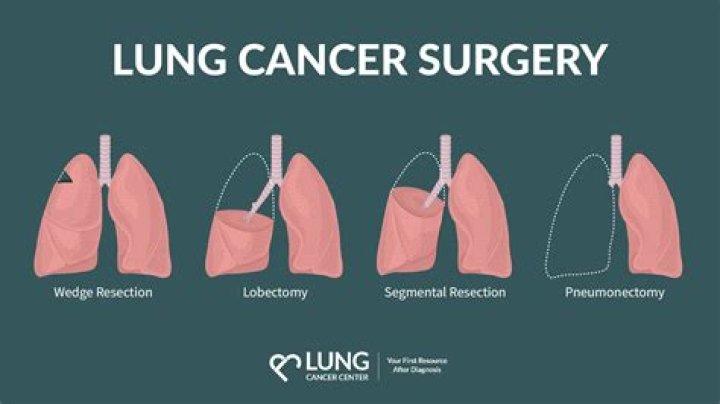 Can you have one lung removed?