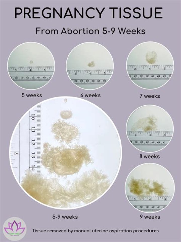 Can you pass tissue in early pregnancy?