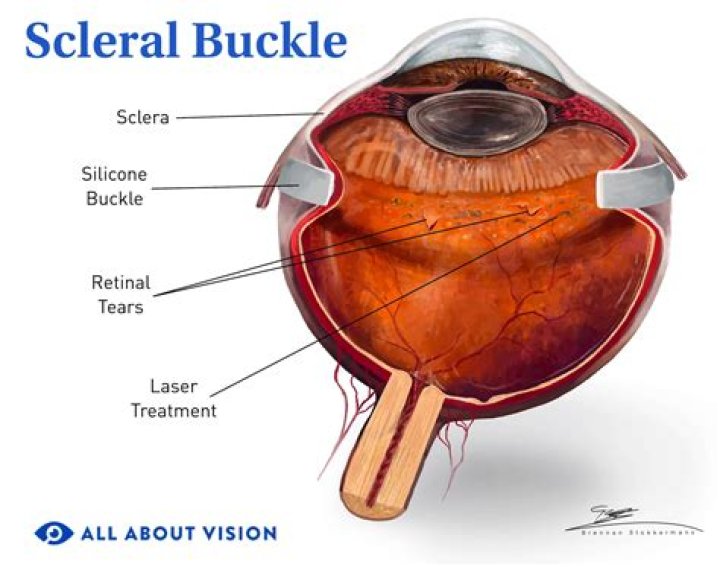 Can you see through sclera contacts?
