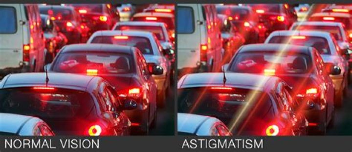 Can your astigmatism axis change?