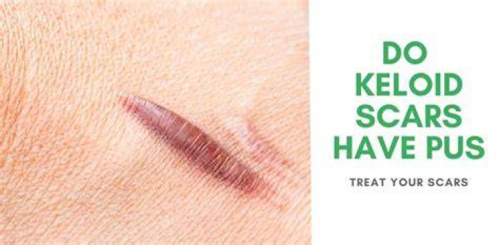 Do keloid scars have pus?