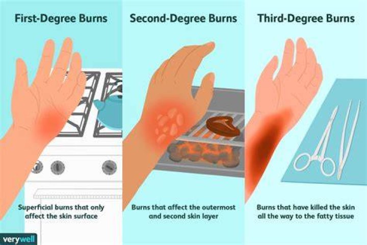 Do oil burns go away?