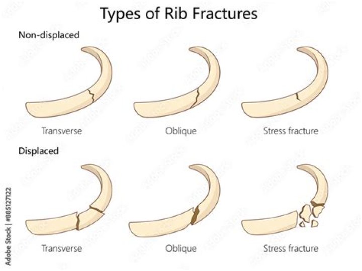 Do rib fractures bruise?
