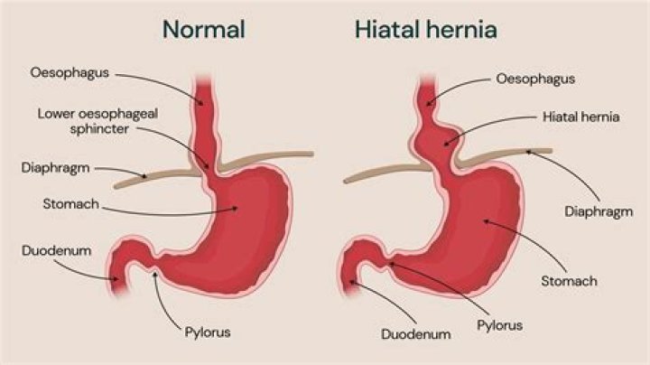Does a hernia throb?