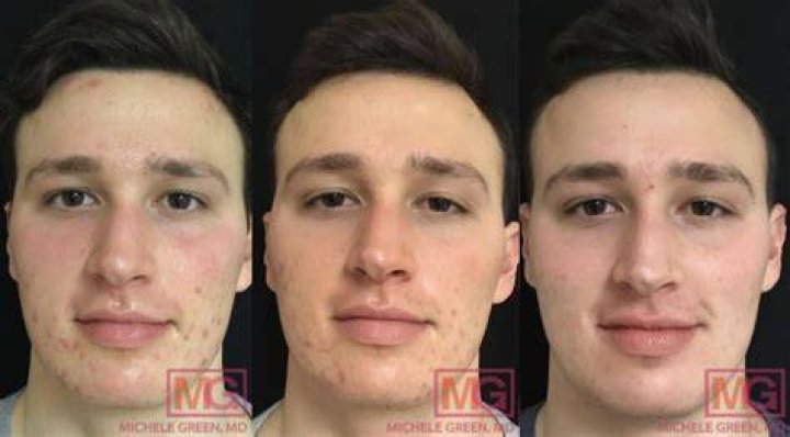 Does accutane get rid of acne scars?