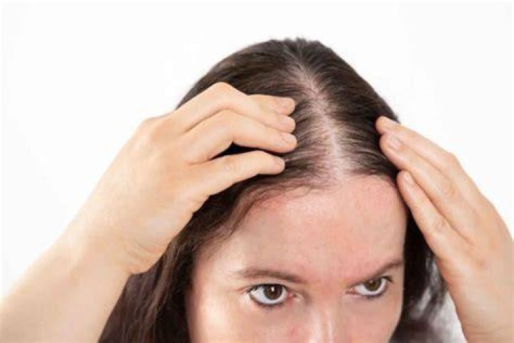 Does drinking milk prevent hair loss?