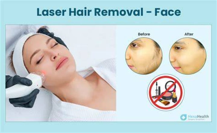 Does laser remove facial hair permanently?