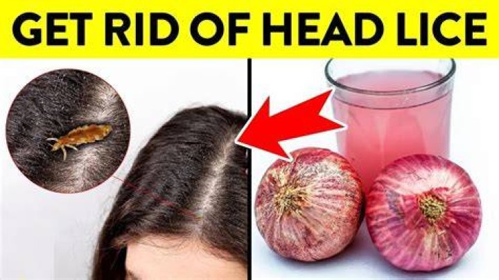 Does onion juice kill lice?
