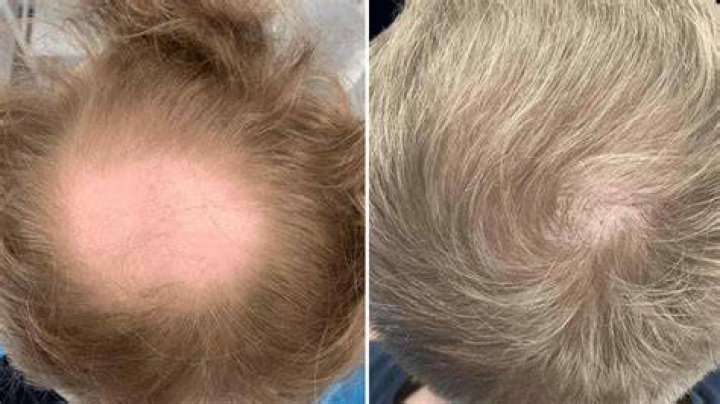 Does pomade cause balding?