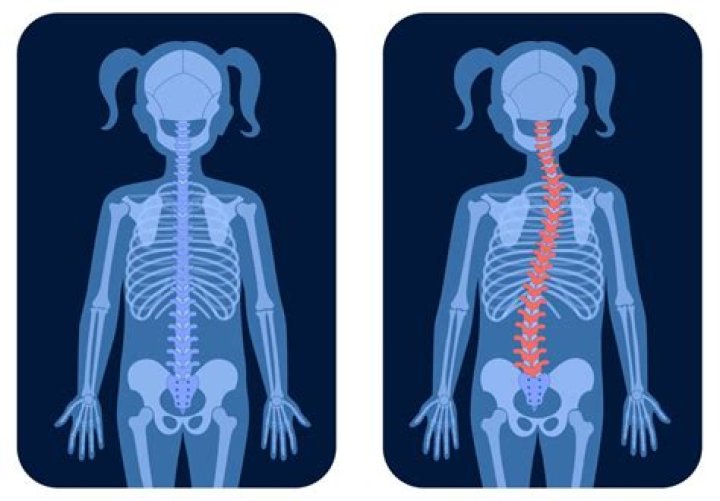 Does scoliosis affect posture? | ContextResponse.com