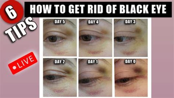 Does tea bags get rid of black eyes?