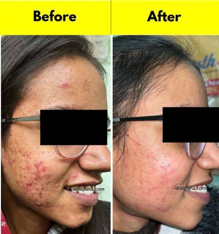 Does Vitex help with acne?