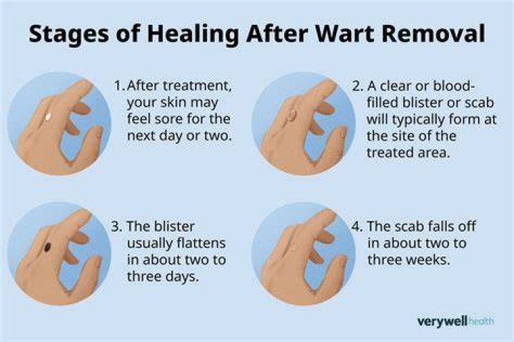 How bad does burning a wart off hurt?
