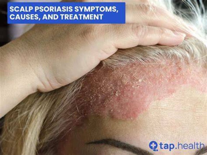 How can I get rid of psoriasis on my scalp?