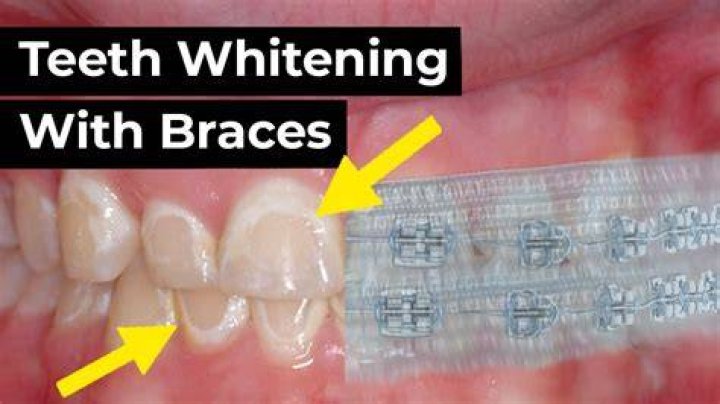 How can I whiten my lips?
