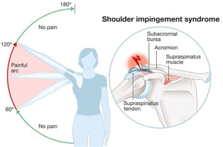 How common is shoulder impingement syndrome?