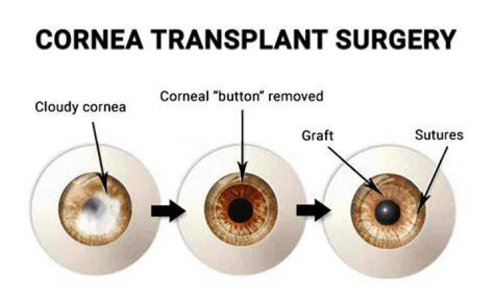 How cornea transplant is done?