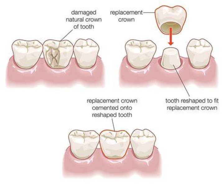 How do dentist remove crowns?