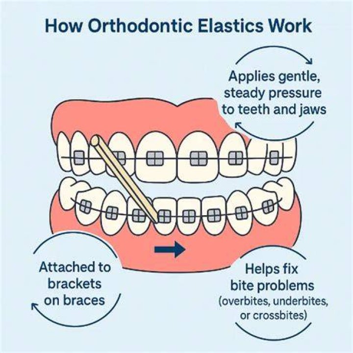 How do elastics work braces?
