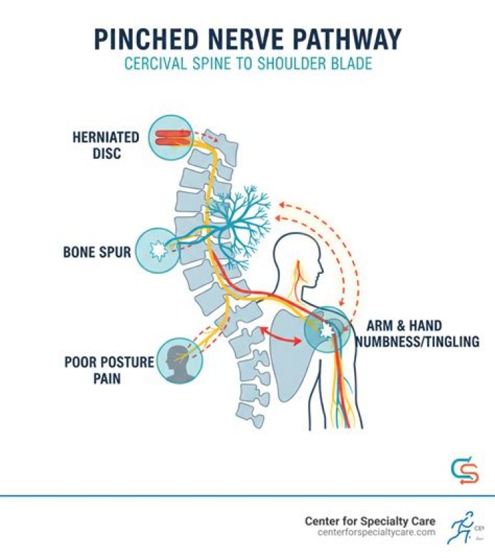 How do I get rid of a pinched nerve in my lower back?