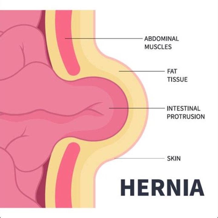 How do I know if I have a hernia or pulled muscle?